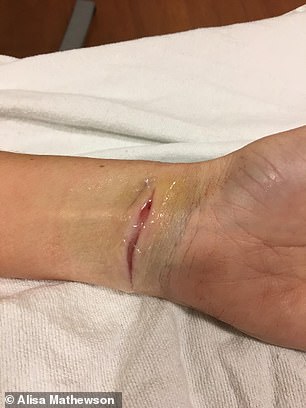 Alisa shared photos of the horrific wrist injuries her husband inflicted on her.