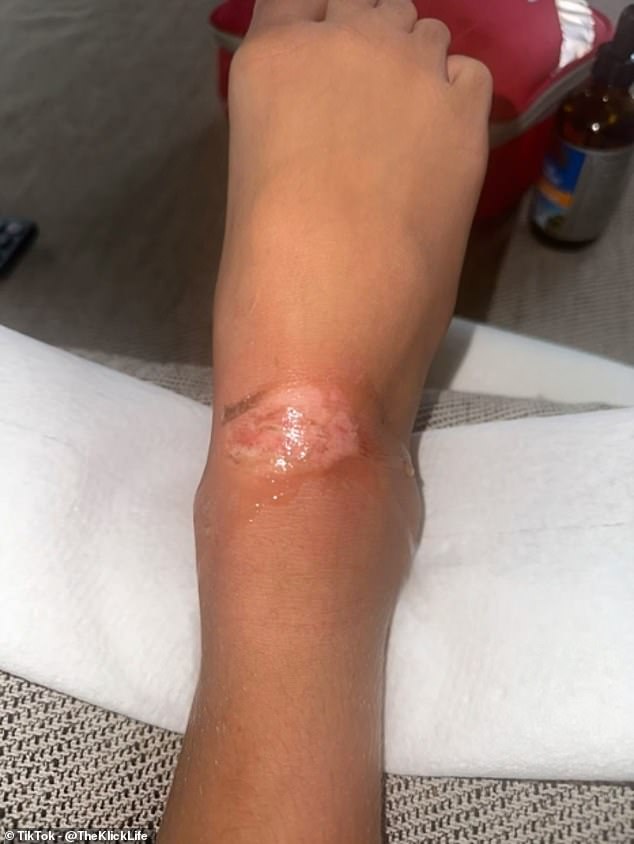 As a warning to others, Ms. Klick posted a video detailing the event on her TikTok and Instagram accounts. Above, a photo of Sienna's burns.