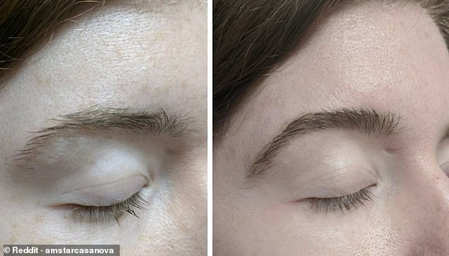 In a Reddit thread with more than 4.1 million members, a user shared images showing the marked difference that three months of using 5 percent minoxidil had supposedly made.