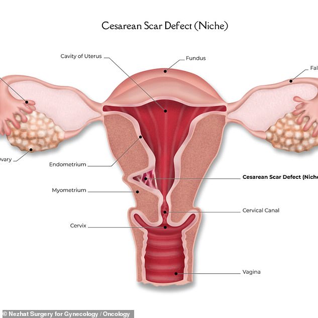 The above, from Nezhat Surgery in New York City, shows what the uterus looks like if it has a scar from a C-section. In a CSEP, the embryo is implanted in the scar.