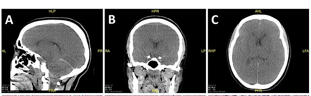 In June, a chronic marijuana user died after the condition caused a fatal heart rhythm disorder. CT scans of the woman's brain showed the extent of damage caused by lack of oxygen when her intense vomiting caused a fatal irregular heartbeat. The folds of the brain have flattened and the entire brain has swollen.