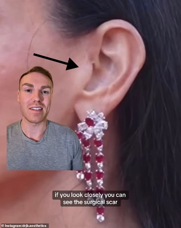 A video from September shows apparent evidence of the surgical procedure, as the star can be seen with her hair tied behind her ear, revealing a surgical scar usually seen after a facelift.