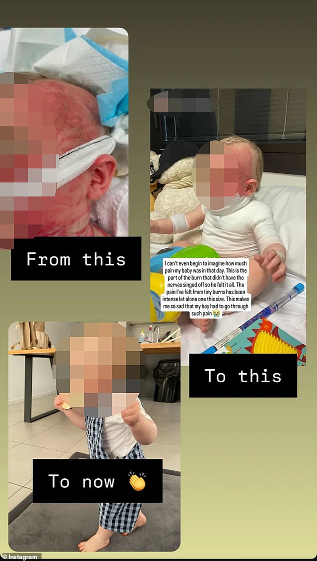 The mother of a baby who was doused with scalding coffee by a stranger and left with life-threatening injuries has spoken out about a major milestone in her recovery.