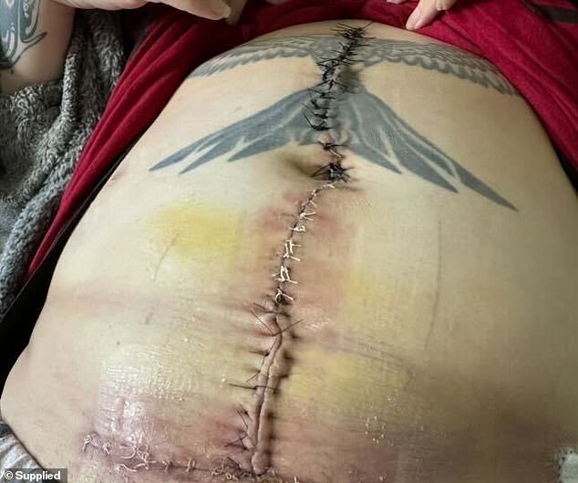 Haylee Loccisano was left permanently disfigured with a 45cm scar on her abdomen