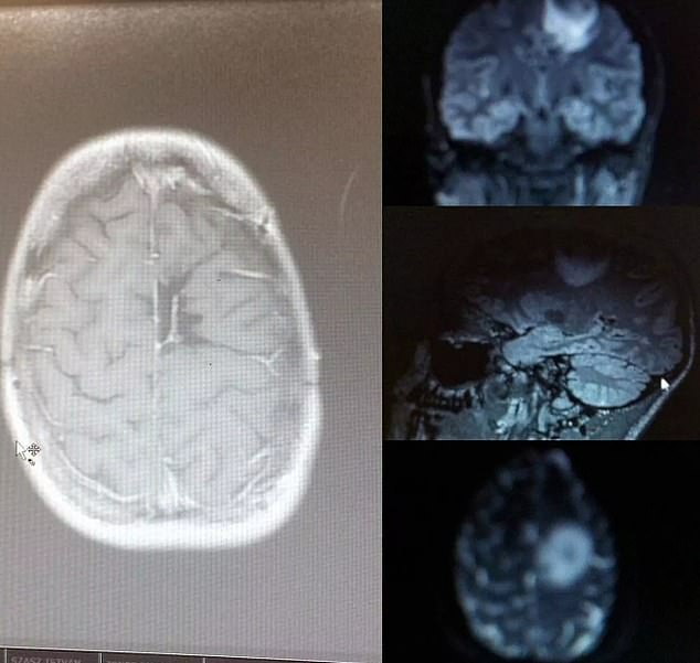 Only after the woman, now 33, fainted twice at the gym did she seek further medical attention. An MRI showed he had a golf ball-sized tumor in his brain.