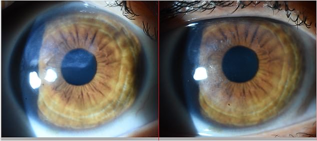 The photograph (left) shows the scar blocking the pupil and vision, and the photograph on the right shows how the specialized treatment eliminated the scar in the pupil area while significantly reducing myopia (nearsightedness).