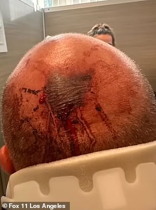 The back of Muder's head was bloody and bruised after his neighbor allegedly attacked him.