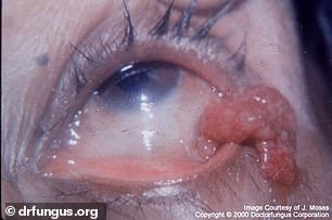 The above shows a patient with a rhinosporidiosis infection, the same infection that the patient in the Indian case study had.