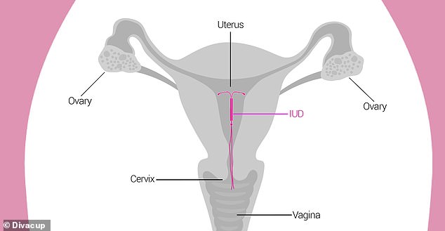 An IUD is inserted into the vagina through a small tube and passes through the cervical opening to the uterus.