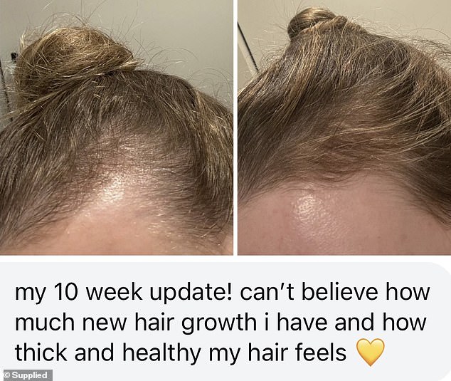 One woman noticed an improvement in the thickness of her hair after 10 weeks of using the scalp serum.