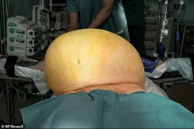 The enormous tumor, shown here just before its removal, weighed 60 pounds and measured 20 inches in diameter.