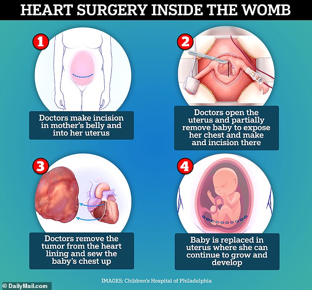 Doctors partially removed Arley from her mother's womb by piercing the amniotic sac, but did not deliver her completely, keeping her protected in the fluid. Specialized devices maintained amniotic fluid levels to minimize risks, preventing the uterus or placenta from reacting to the surgery.