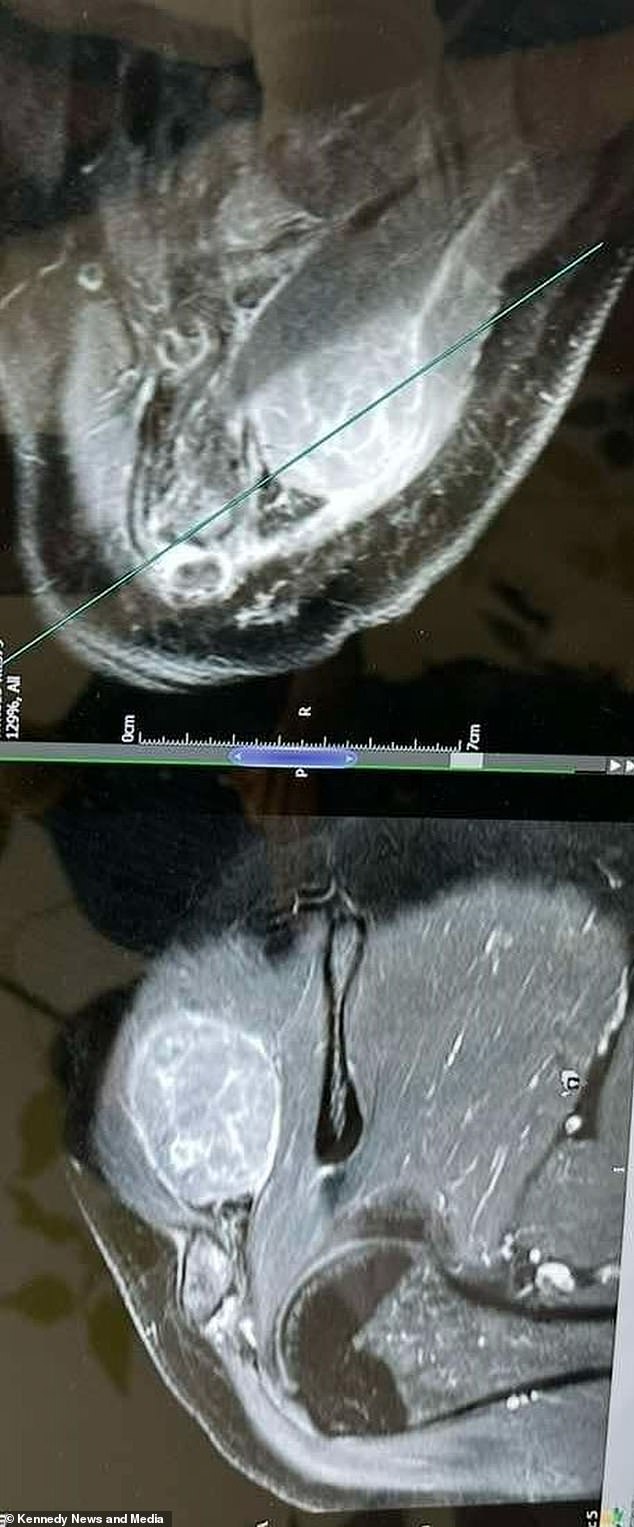 In January, Ms Turner underwent a biopsy and scans which revealed stage four melanoma. The image above shows the scan of Mrs Turner's shoulder, with the tumor in white.