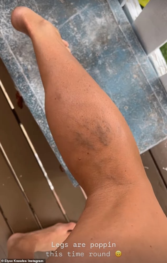 The model, 32, who is expecting her third child with fiancé Josh Barker, 35, took to her Instagram Stories on Friday to share a video of her bruised-looking legs.