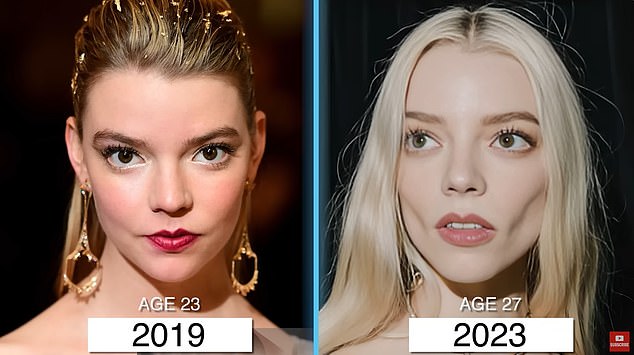 Plastic surgeons also suggested that Anya Taylor-Joy undergo buccal fat removal. Dr. Linkov suggested she undergo the procedure in one of his videos, after comparing photos of her from 2019 to 2023.