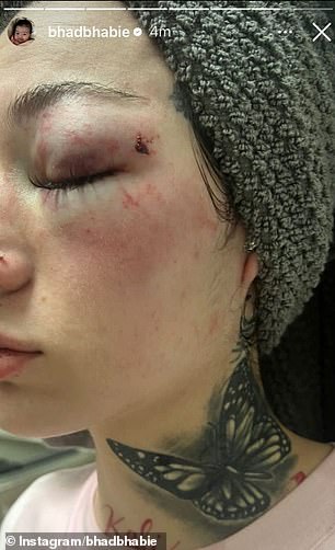 She followed the video with photos of herself sporting a nasty black eye and bruises all over her face.