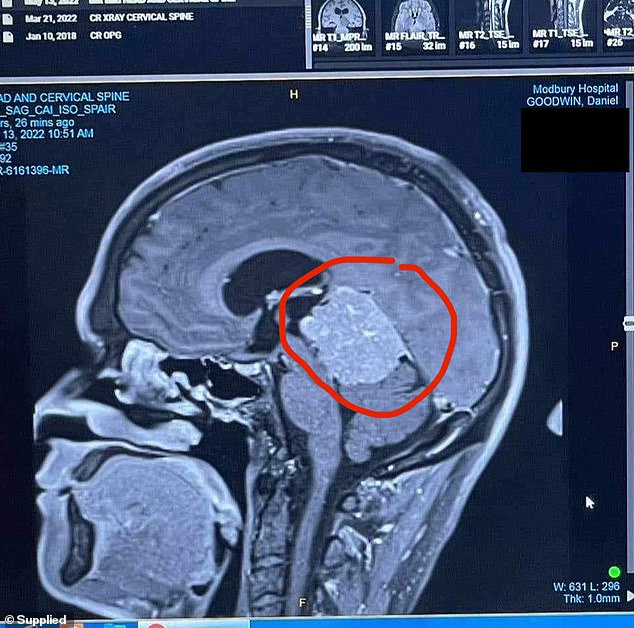 Mr Goodwin's MRI revealed a 5.2cm tumor in his brain pressed against a main artery.