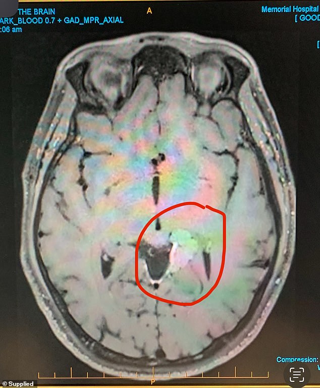 The tumor (pictured) has since grown back to about half its original size, about 2.9mm.