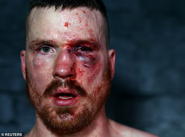 Peter Radford with horrible bruises after his fight in Wolverhampton