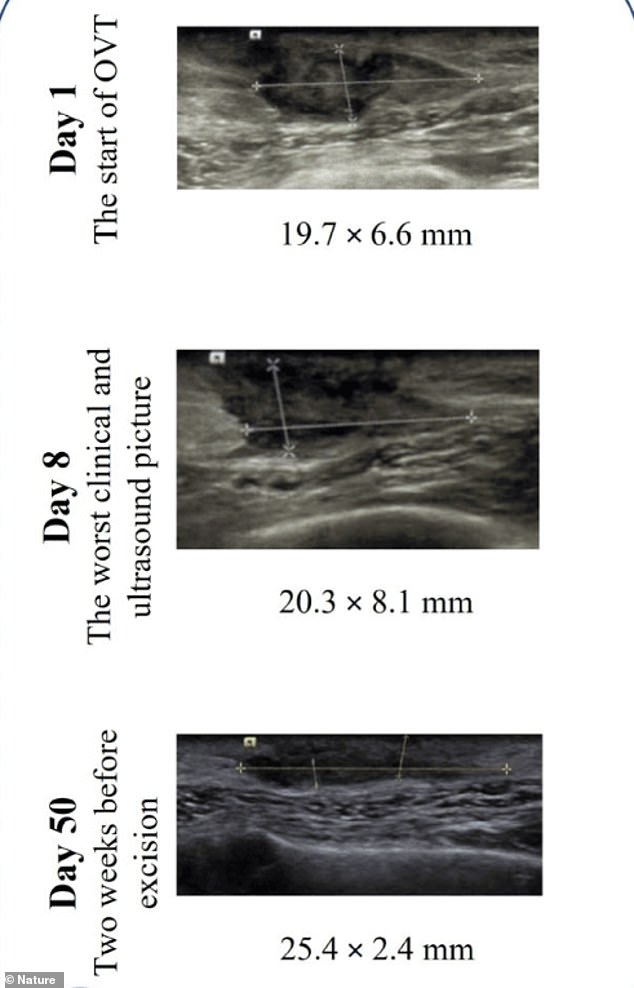 The three panels show that the tumor (measured by the two perpendicular lines) shrinks over time, making it easier to remove surgically.