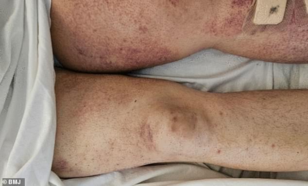 The man, who recently underwent bariatric surgery to lose weight, had a reddish-brown, pinpoint rash that covered his legs (pictured) and spread to his hands and arms.