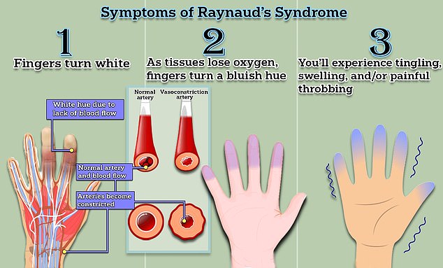 Raynaud's disease causes miniature spasms in the blood vessels, cutting off the blood supply to the fingers and toes.