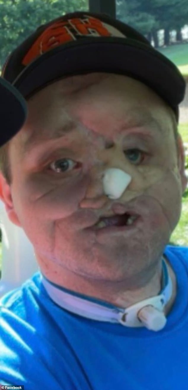 Derek was left with horrific facial injuries and could no longer smile, eat solid food, blink or smell. He underwent nearly 60 emergency surgeries before his facial reconstruction.