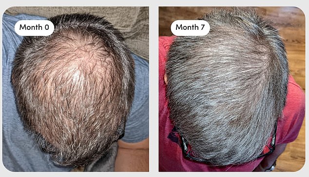 The images above, his, show a man before taking finasteride and seven months after starting the drug.