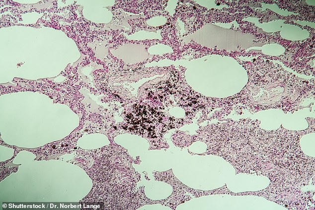 Silicosis, through the fine particles that workers inhale, causes internal scarring and inflammation of the lungs. Image of silicosis of lung tissue with magnification.