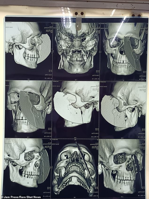 X-rays taken before the worker underwent surgery show the metal blade embedded in the middle of his face.