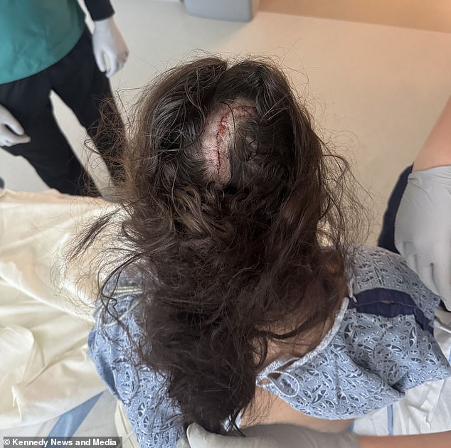 Doctors made an incision in his scalp and removed part of his skull. Then, they removed the tumor, making sure not to damage the healthy tissue surrounding it.