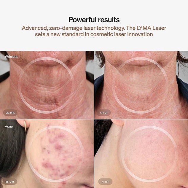 The LYMA laser has been shown to deliver some pretty amazing results, from fewer lines and wrinkles to reduced hyperpigmentation.