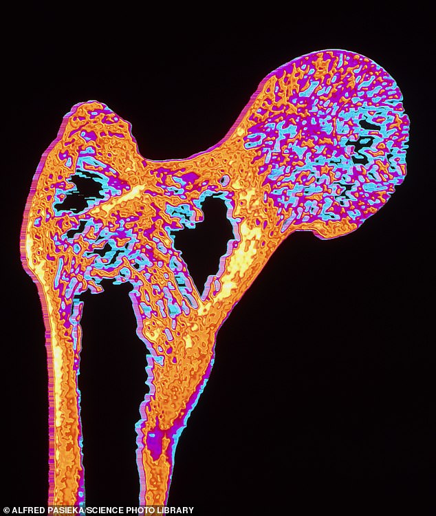 Research has long suggested that too much thyroid hormone accelerates bone loss, increasing the risk of osteoporosis, a bone-thinning disease. In the image, x-ray of the head of a femur suffering from osteoporosis.