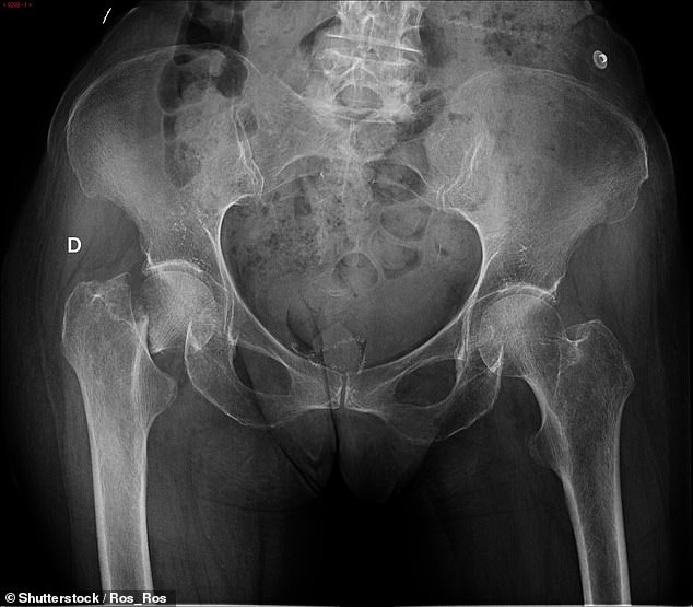 This x-ray shows a woman with a hip fracture, which is one of the most debilitating fractures associated with osteoporosis, according to Yale. Thyroid problems are much more common in women than in men.