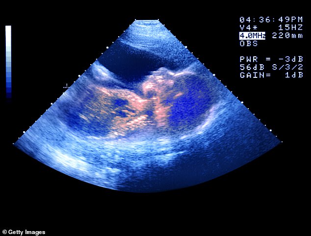 Between 2012 and 2022, single women using IVF or donor insemination increased from 1,400 to 4,800 (file image)