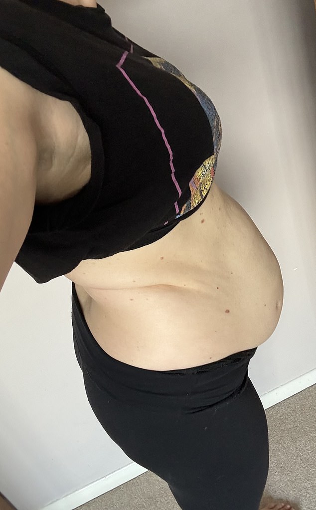 In most moderate cases, if the muscles do not come back together naturally, physical therapy exercises during the first year after birth usually help. In the photo: a woman with diastasis recti.