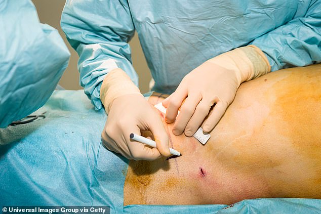 Women undergo tummy tucks and mommy or 'granny' makeovers, including mini brachioplasties, which reshape flabby arms without leaving large scars.