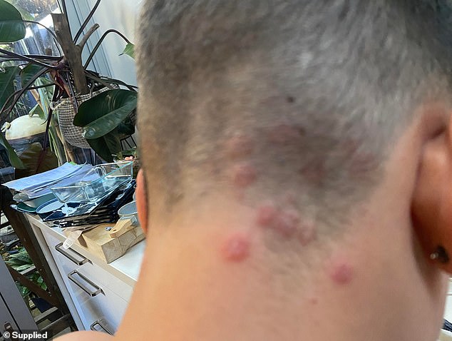 Barbers believe this is because more and more men are opting for haircuts that discolor the skin. Pictured is a 2022 case in Australia of a child who contracted ringworm after visiting the barber.