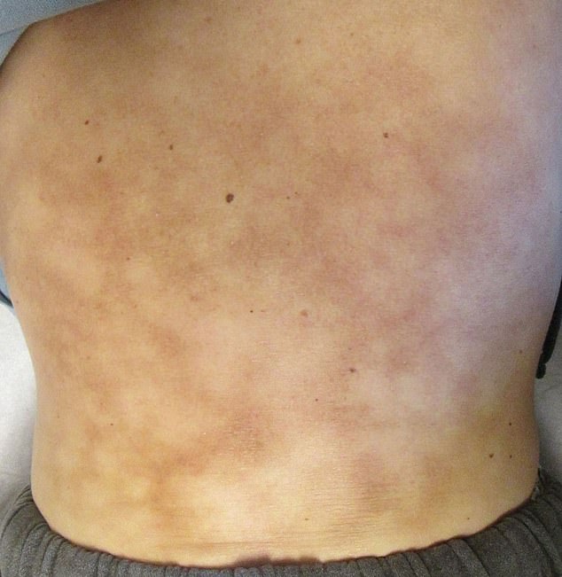 An article published in the Cleveland Clinic Journal of Medicine discusses a severe case of erythema ab igne in a 42-year-old man.