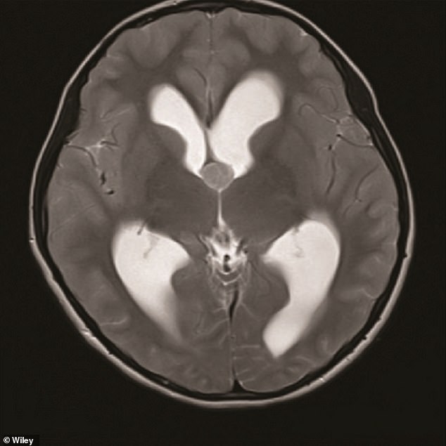 Colloid cysts, which are filled with a thick gel-like substance called colloid, are usually asymptomatic. Pictured is a case report published in the journal Wiley showing the cyst in the center of the brain scan (gray circle).