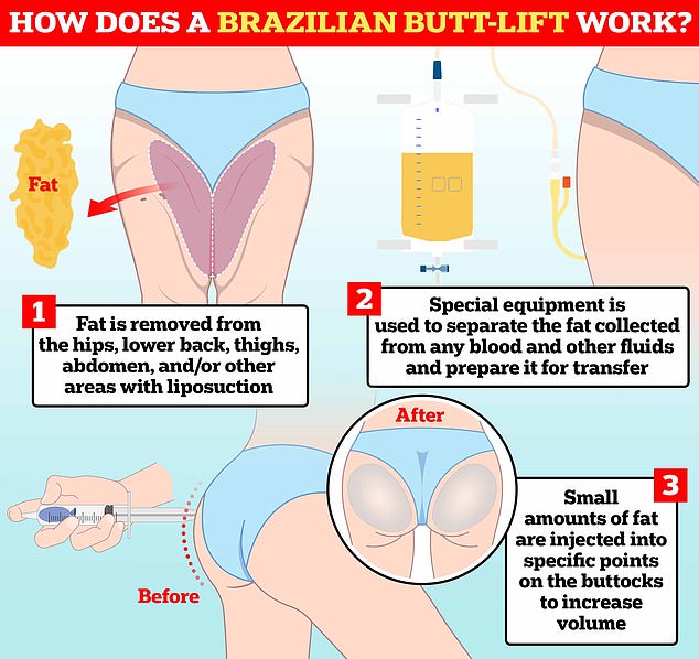 Fat is first removed from the hips, lower back, abdomen, thighs, and other areas using liposuction. Special equipment is used to prepare it for transfer before it is injected directly into the buttocks at specific points, giving the buttocks a larger, curvier appearance.