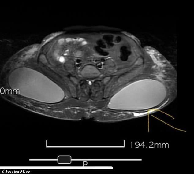 Shocking: Jessica's lower x-ray shows implants starting to pop out of giant hole in her lower cheek