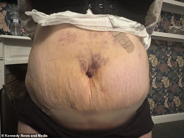 Ms Guest now faces further surgeries to remove the three bruises on her stomach which doctors discovered in the UK.