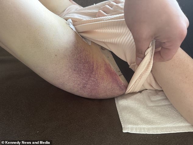 She was left covered in bruises after 'mummy makeover' procedure