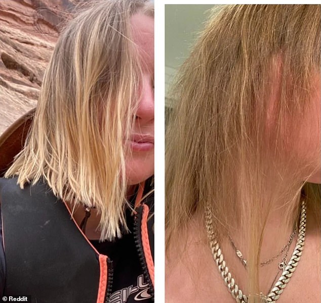 ACCUTANE: The woman mentioned above posted on Reddit about her hair loss while using acne medication. She is photographed three months after taking the medication (left) and 10 months after stopping it.