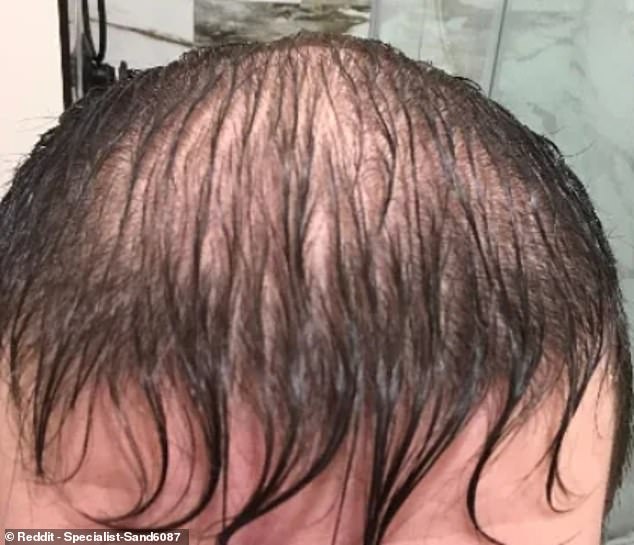 AFTER ACCUTANE: This person said Accutane caused hair loss. In an online post, he said that 