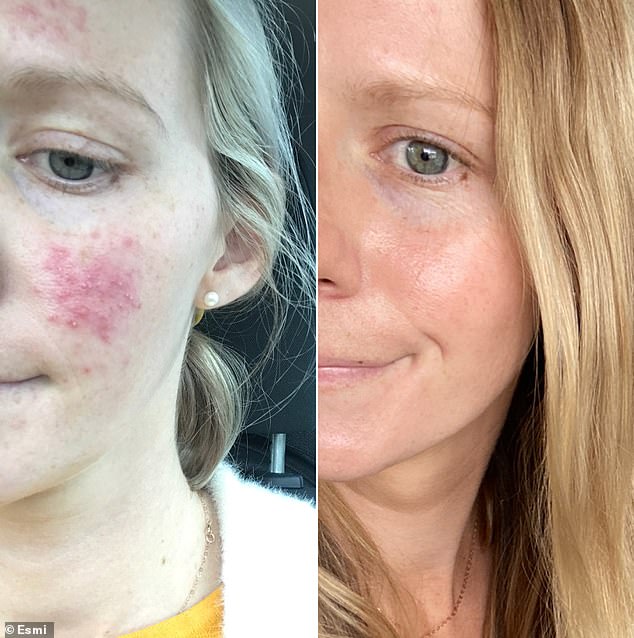 Megan, who developed skin problems during pregnancy, shared her positive experience with the serum after a year of adjusting her skincare and diet.