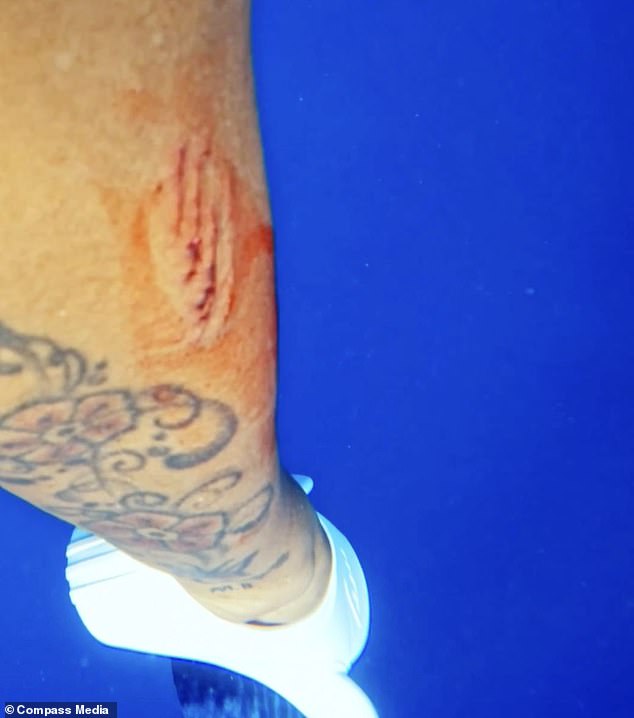 In the photo: Blood runs down Lilian's leg after she was bitten by the shark last month