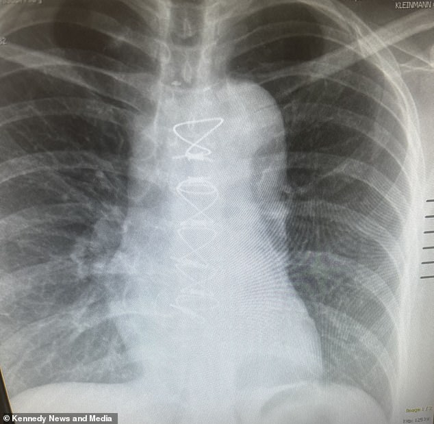 Above, an x-ray showing where surgeons inserted an artificial tube, called a graft, to replace the weak section of Ms. Anderson's aorta.