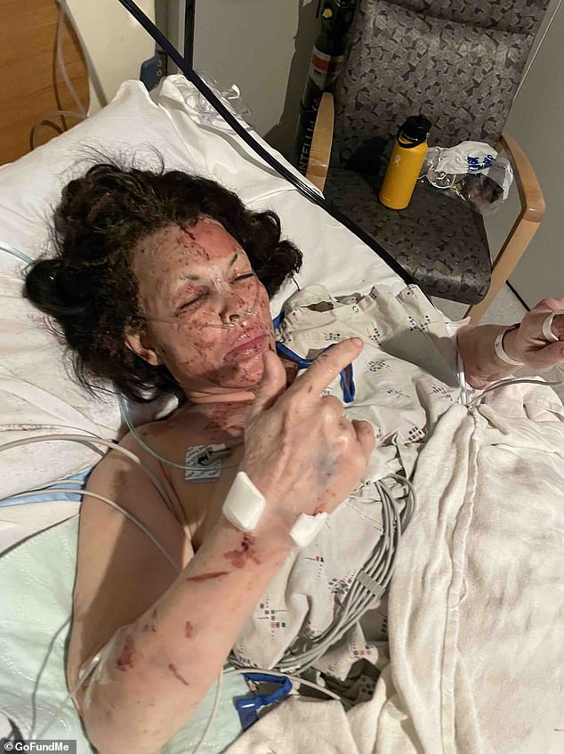 She was left covered in burns and cuts and told a local newspaper that she had suffered a traumatic brain injury